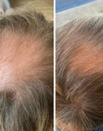Trudermal Halo LED Hair Growth Cap
